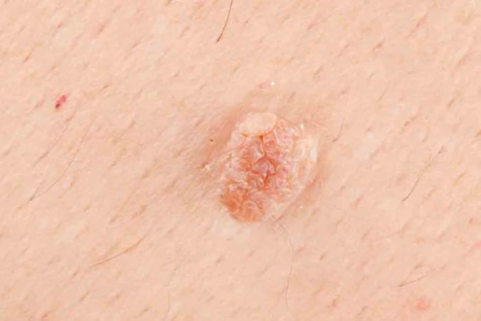 Affordable services for male genital warts laser in Mashhad